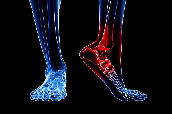 Разрыв связок